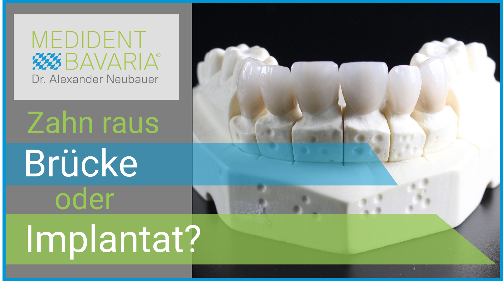 Zahn raus – Brücke oder Implantat?